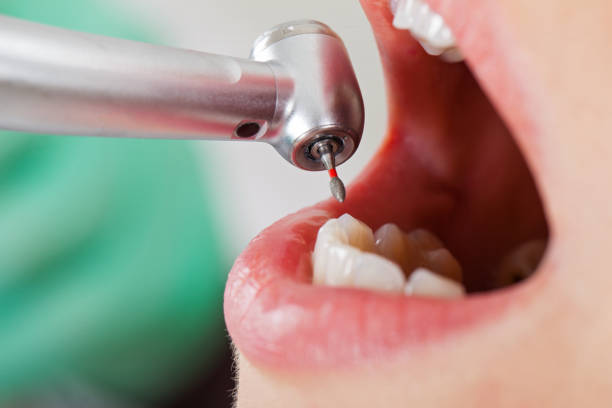 Best Lost Filling or Crown Replacement in Sunnyside, GA